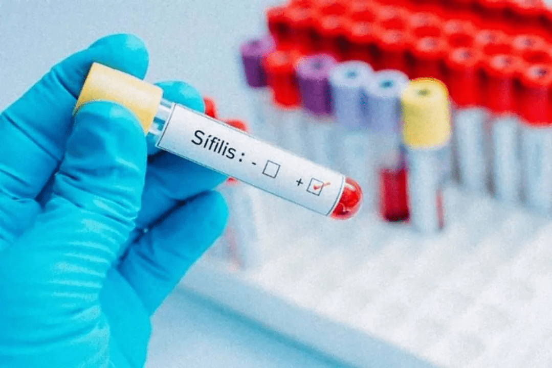 sifilis en Argentina